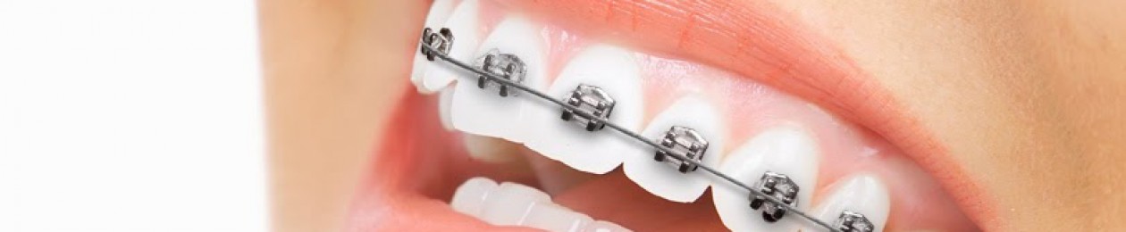 settling elastics in orthodontics