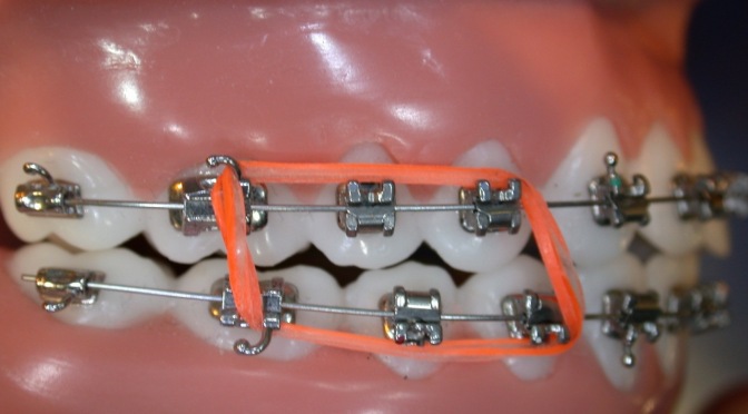 Orthodontic Elastics  Saudi Orthodontics Club